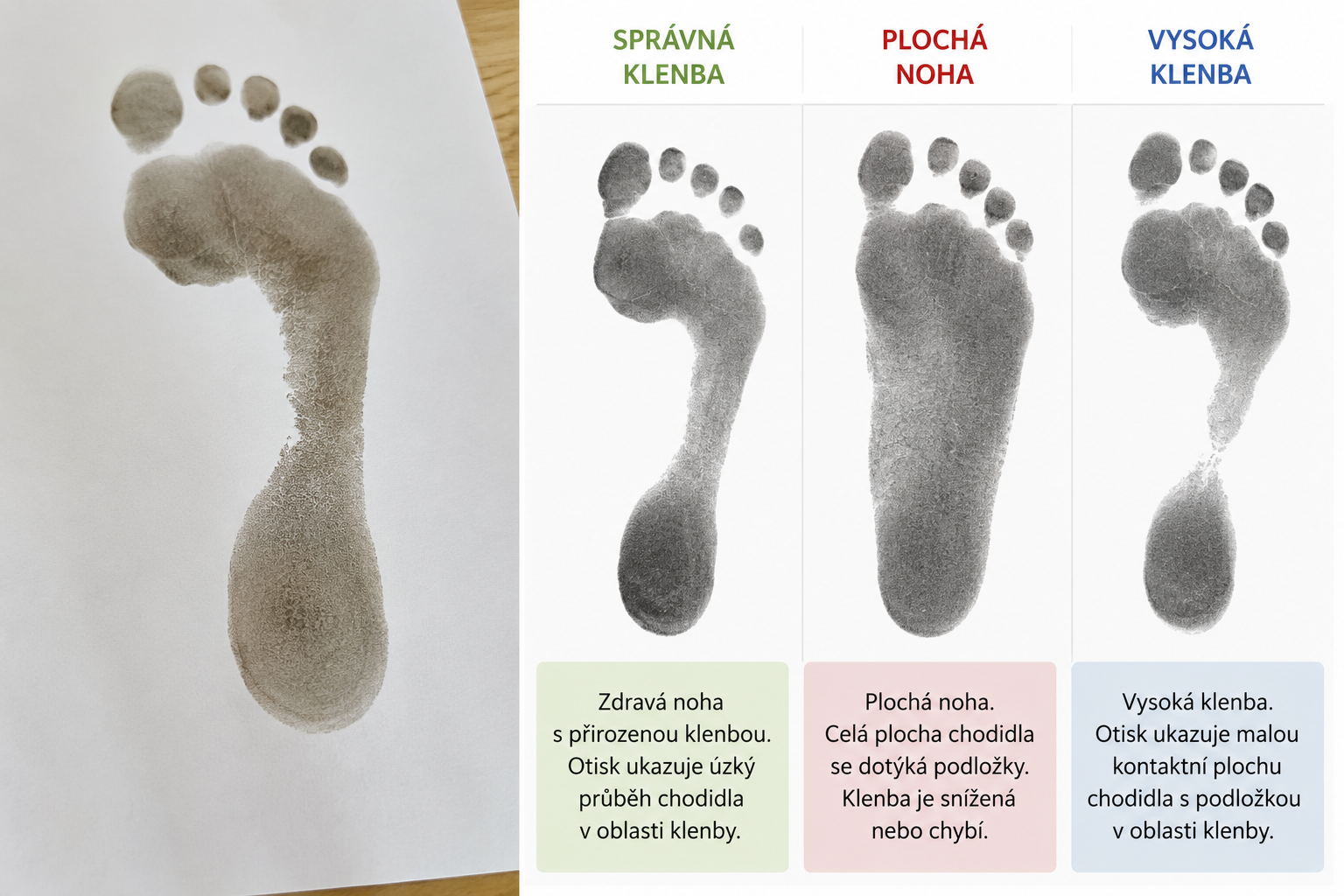 Koláž otisků chodidel s popisky správná klenba, plochá noha a vysoká klenba na bílém pozadí.